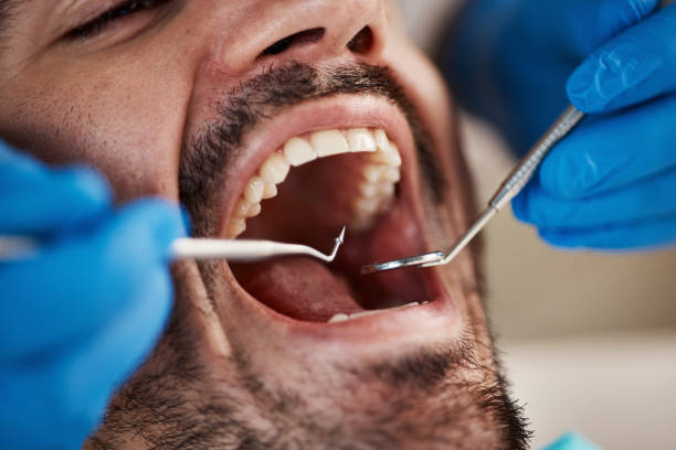 Best Emergency Wisdom Tooth Extraction in Taylor, AZ