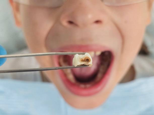 Best Emergency Wisdom Tooth Extraction in Taylor, AZ